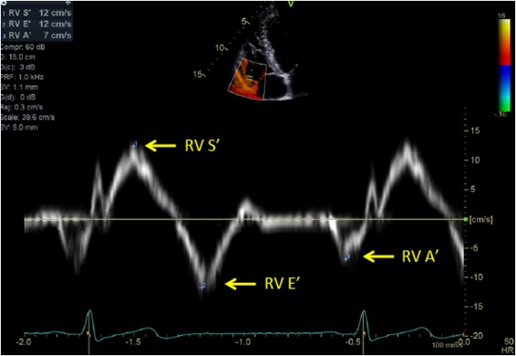 Doppler-derived right ventricular systolic excursion velocity (RV S’)