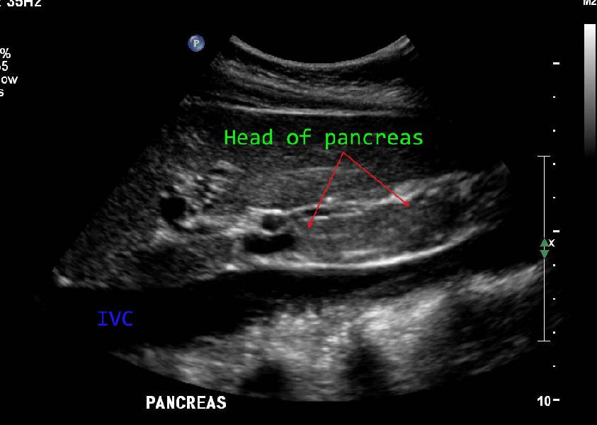 Echographie tête du pancréas