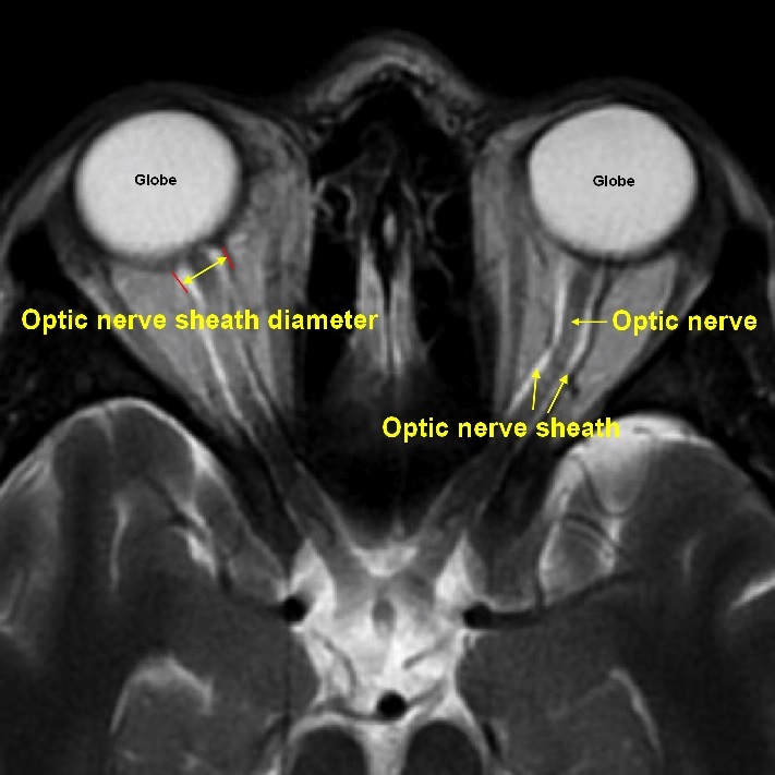 mesure de la taille du nerf optique (IRM)