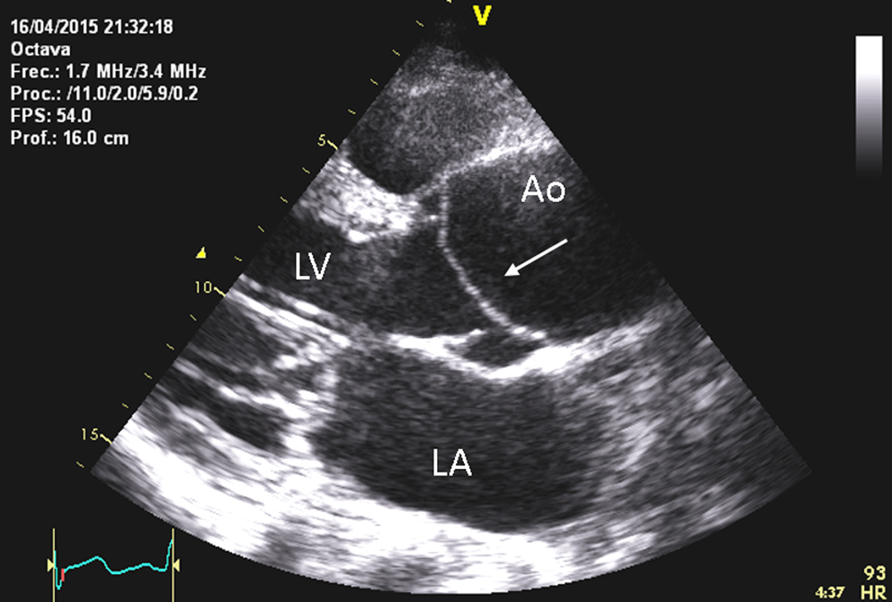 Dissection de l'aorte ascendante