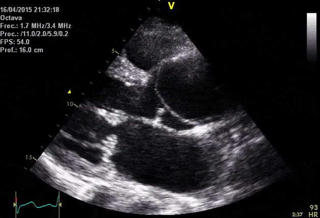 Dissection de l'aorte ascendante