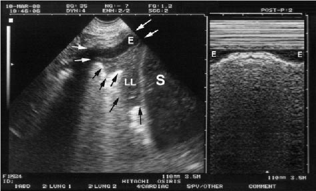 épanchement pleural: Repérage transverse